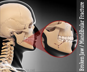 Broken Jaw | Mandibular Fracture - Types, Causes, Symptoms, First Aid ...