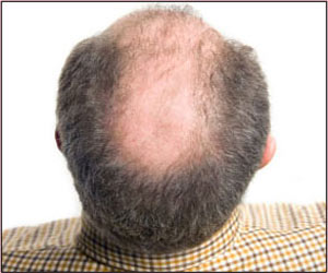Meaning alopecia Hair Loss