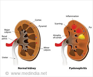 Pyelonephritis - Causes, Symptoms, Diagnosis, Treatment & Prevention