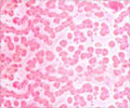 Test Your Knowledge on Anemia