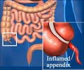 Quiz on Appendicitis