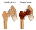 Quiz on Bone Cancer Quiz on Bone Cancer