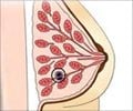 Quiz on Breast Cancer