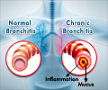 Quiz on Bronchitis