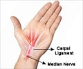  Carpal Tunnel Syndrome