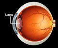 Quiz On Cataract
