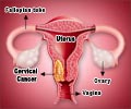 Quiz on Cervical Cancer Quiz on Cervical Cancer