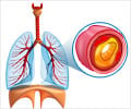 Quiz on Cystic Fibrosis Quiz on Cystic Fibrosis
