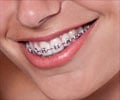 Quiz on Dental Braces