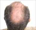 Quiz on Hair Loss 