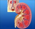 Quiz on Kidney Stones Quiz on Kidney Stones