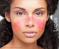 Quiz on Lupus