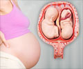 Quiz on Multiple Pregnancy