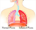 Quiz on Pleurisy (Advanced)