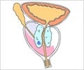 Quiz on Prostate Cancer