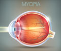 Test Your Knowledge on Short-sightedness (Myopia)