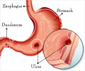 Quiz on Ulcer