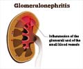 Test Your Knowledge on Glomerulonephritis - Kidney Disease