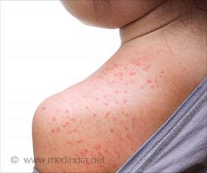 Skin Disease Prickly Heat Rash Or Miliaria On Back Skin Of Asian