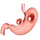 Helicobacter pylori Antibiotic Treatment of Peptic Ulcer May not Prevent Gastric lymphomas
