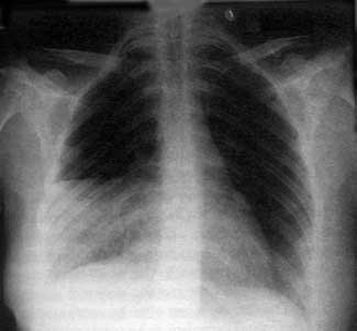 Malignant Mesothelioma – A New Genetic Revelation
