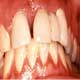 Tooth Decay Bacteria Unaffected By Altered Biochemical Pathway