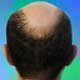 Sporting the Naked Pate: On Hair Loss and Balding