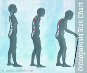 Osteoporosis Chart