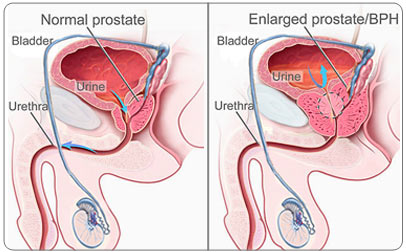 prostate volume size calculator prostate cancer foundation grants