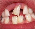 दाँत क्षय या दाँत की हानि