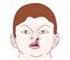 Cleft Lip Repair - Animation