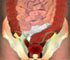 Inguinal Hernia Animation - Cause and Symptoms - Animation