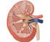 Pyeloplasty of Kidney Pyeloplasty of Kidney