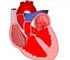 Mitral Valve Disease and Replacement - Animation Mitral Valve Disease and Replacement - Animation