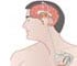 Parkinson's Disease - Surgical Treatment - Animation Parkinson's Disease - Surgical Treatment - Animation