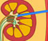 Animation On Key Hole Surgery for Kidney Stone Removal or Percutaneous Nephrolithotomy (PCNL)