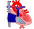  Patent Ductus Arteriosus (PDA) - Animation