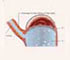Reflux Esophagitis - Animation