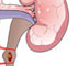 Open Ureterolithotomy - Animation