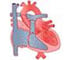 Ventricular Septal Defect (VSD) - Animation Ventricular Septal Defect (VSD) - Animation