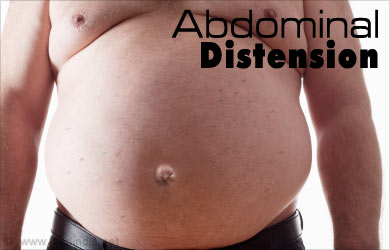 Distensión abdominal síntomas
