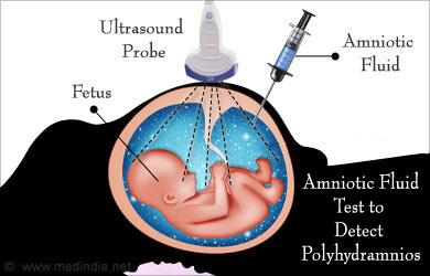 Amniotic Fluid Index Ultrasound