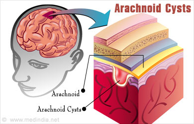 Arachnoid Cyst Size Chart