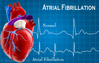 Atrial Fibrillation - Causes, Symptoms, Diagnosis, Treatment ...
