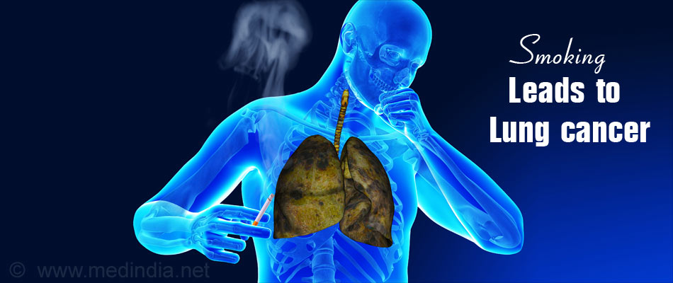 Lung Cancer Types Causes Symptoms Diagnosis Treatment And Prevention