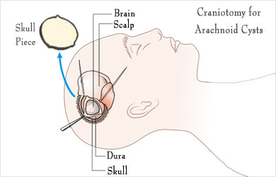 Arachnoid Cyst Size Chart