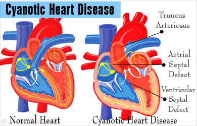 Cyanotic Heart Disease - Causes, Symptoms, Diagnosis, Treatment