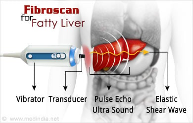 Liver Fibroscan Chart