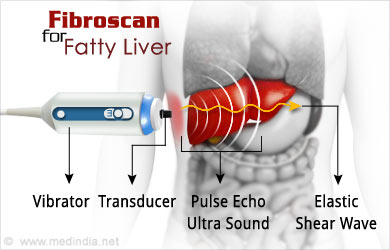 Liver Fibroscan Chart