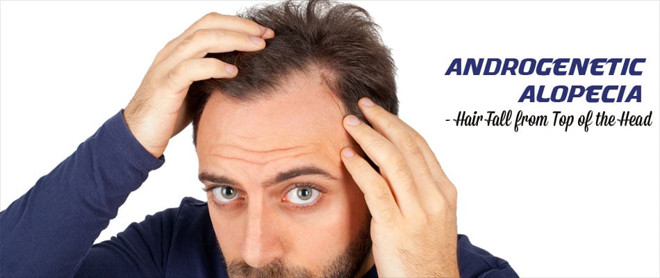 Alopecia Areata Hairless Patches Homeopathic Treatment I Types Symptoms  and Diagnosis